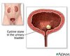 cystinuria.jpg