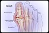 mifupa ya gout.jpg