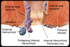 hemorrhoids-s10-illustration-of-thrombosed-external-hemorrhoids.jpg