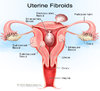 1uterinefibroids.jpg