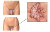 genital warts.jpg