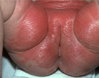 diaper_candidiasis5.jpg