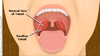 tonsil.png