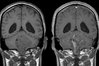 brain-tumor-mri.jpg