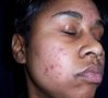 acne.jpeg acne.jpeg
