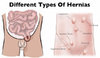 different  -hernias.jpg