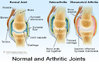 arthritic_joints.jpg