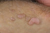 genital-warts-picture-112-300x197.jpg