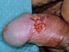 herpes-genitalis-1.jpg