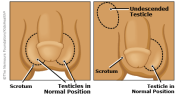 undescendedTestA-415x233-esIL-1.png