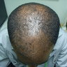 Alopecia
