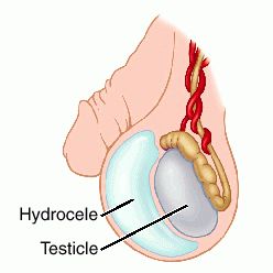 Hydrocele-Pictures.jpg