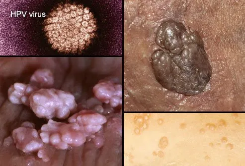 stds-s1-photo-of-genital-warts.jpg