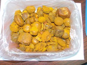 Ethiopian-Ox-gallstones-300x225.jpg