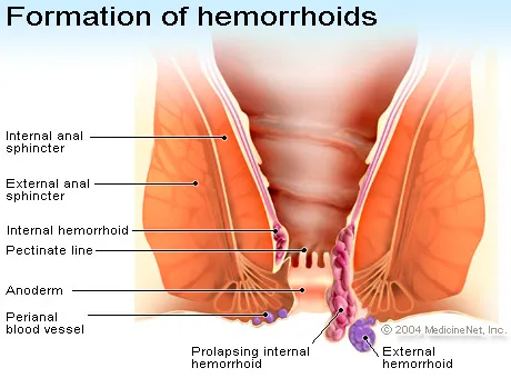 hemorrhoid.jpg