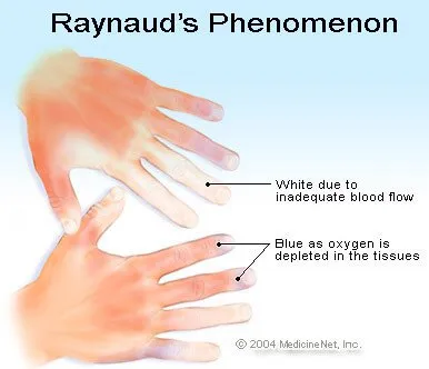raynauds_phenom.jpg