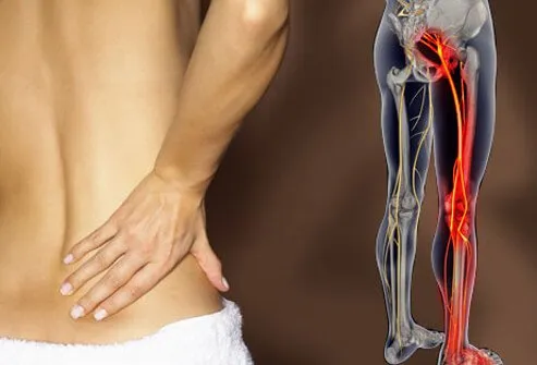 sciatica-s2-photo-of-lower-back-pain.jpg