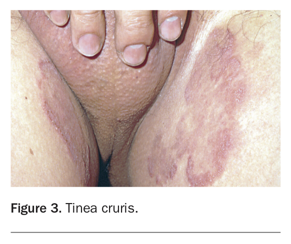 F3-Nguyen-Fungal-infections.jpg