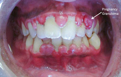 pregnancy-gingivitis.jpg
